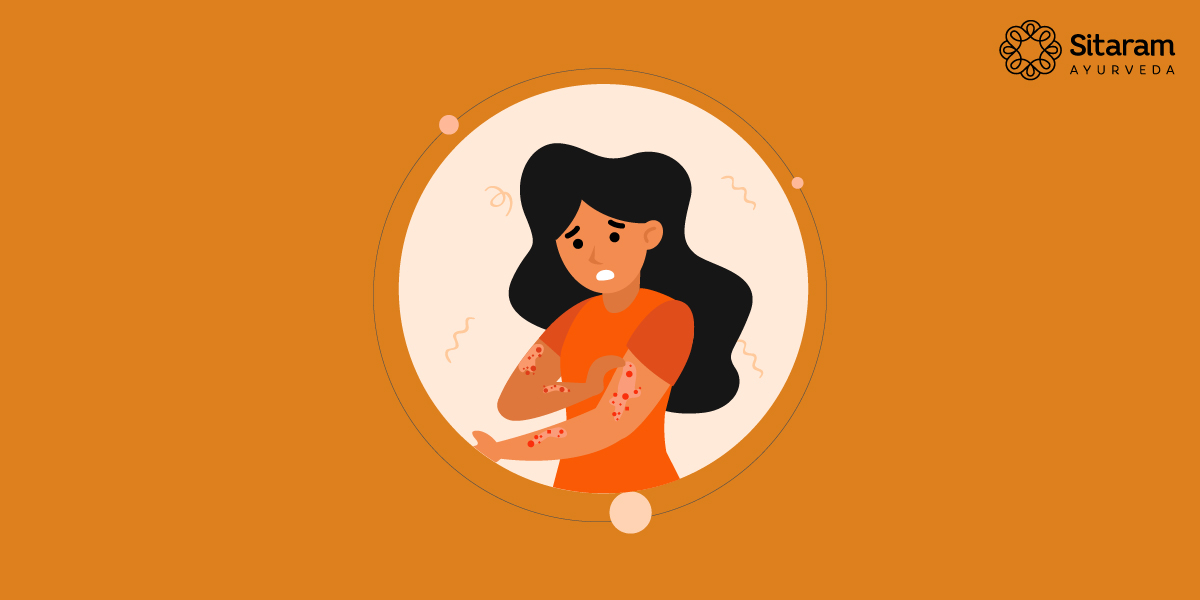 Ayurvedic Solutions for Eczema: Natural Treatment Approaches