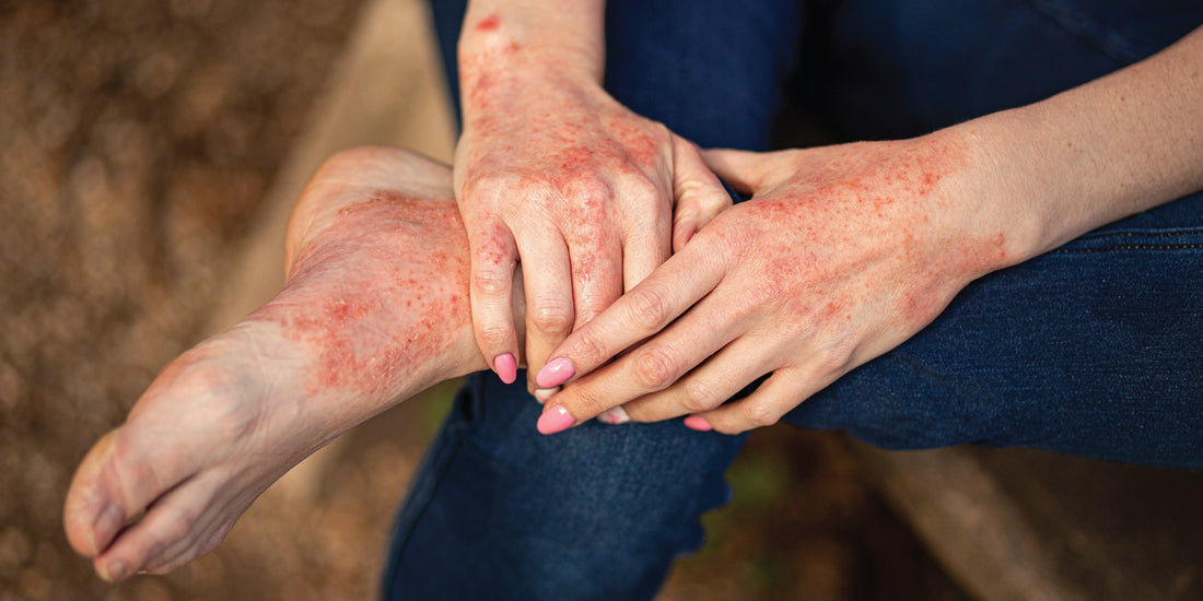 Ayurvedic Solutions for Eczema: Natural Treatment Approaches